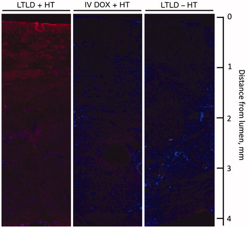 Figure 3. Cross sections of bladder wall showing doxorubicin (red) and cell nuclei (blue) in animals treated with LTLD + HT, IV DOX + HT and LTLD – HT arranged with luminal surface at the top and serosal surface at the bottom. The highest fluorescence intensity of DOX was observed for LTLD + HT compared to IV DOX + HT and LTLD − HT groups in both the mucosa and muscle. (Refer the online version for color figure.)