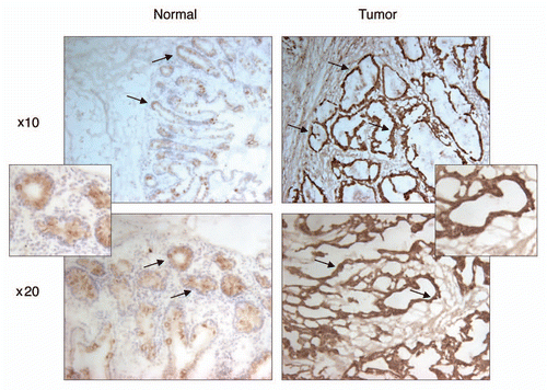 Figure 4 Immunohistochemical staining of PDRG in matched normal and cancer tissues from colon cancer patients. Frozen primary colon normal and tumor tissues from same patient were sectioned (6 µm) then fixed with 4% paraformaldehyde for 30 min. Endogenous peroxidase was quenched with hydrogen peroxide and the sections were then blocked in PBS with 10% goat sera for 20 min and incubated sequentially with anti-PDRG antibody for 1 hour, biotinylated anti-rabbit secondary antibody (Vector Laboratories, Burlingame, CA) for 45 min and ABC reagent (Vector laboratories) for 30 min. After several washes, the sections were then incubated with peroxidase substrate DAB solution (Vector laboratories) and counterstained with hematoxylin. Brown color indicates the PDRG-specific signal. Photomicrographs from different regions captured at x10 and x20 magnifications are shown. Please note that PDRG1 is predominantly expressed by the epithelial cells as indicated by arrows and the tumor sample exhibits very strong PDRG-specific staining than the matching normal tissue. Insets show sections of enlarged images from x20 photomicrographs.