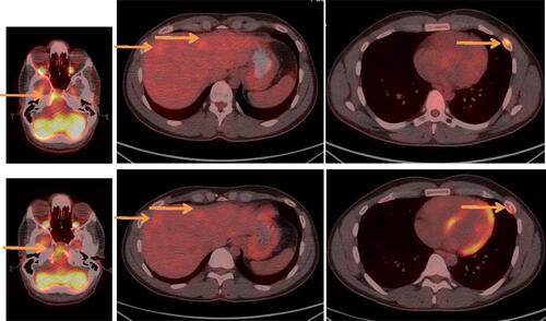 Figure 1 FDG PET/CT of patient 1. Upper line showing clivus, liver and rib lesions before therapy and lower line showing the same lesions after the administration of 6 cycles of Doxorubicin plus Olaratumab. Arrows highlight the lesions.