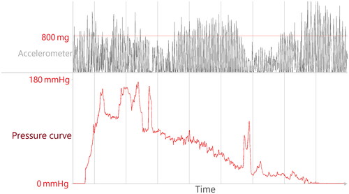 Figure 2. Original data; example of cuff-based measurement matching criteria for artefact 1 (activity) and 2 (cuff error). The red line in the Top panel represents 800 mg (0.8 times the earth’s gravitational force) and is our cut-off for excessive motor activity. The lower panel displays the heavily impeded inflation/deflation curve.