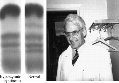 Figure 1. C‐B Laurell (1919–2001). Photographed in Malmö in 1972. Left, the original paper electrophoretic strips from 1962 showing the almost complete absence of the alpha‐1 band from the plasma of a respiratory disease patient.