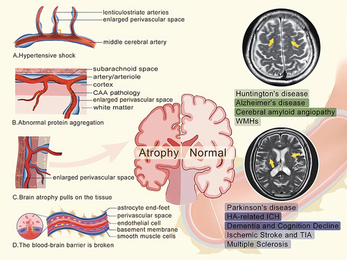 Figure 1 The hypotheses of the cause mechanisms of perivascular space enlargement.