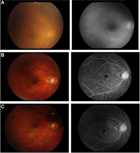 Figure 2 Fundus color photograph (left) and fluorescein angiography (right) of the right eye.