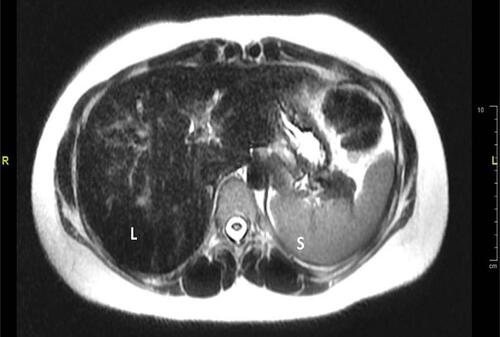 Figure 2 Axial T2 weighted image of the liver showed dark signals of the liver (L) relative to normal signals of spleen (S) due to iron deposition.