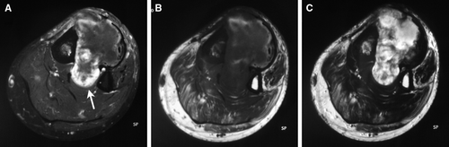 Figure 4.  Magnetic resonance imaging demonstrated that the contents of the masses were isointense with muscles on T1-weighted images and hyperintense on T2-weighted images, with peripheral low signal intensity foci representing calcification. Postcontrast fat-suppressed T1-weighted image showed peripheral ring enhancement (arrow).
