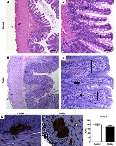 Figure 1 General colon anatomy of common marmosets with normal or colitis conditions. (A,a; B,b) Colon sections from marmosets were stained with HE and evaluated for the presence of colitis (Table 1; A,B =10×, scale bar =100 μm; a,b =40×, scale bar =50 μm). G, gland; L, luminal surface; MP, myenteric plexus; S, serosal surface; +, submucosa; *, goblet cell; black arrowhead, resident lymphocyte; black arrow, eosinophil; vertical black bar, lamina propria between adjacent glands. Note inflammatory infiltration of the lamina propria causing mucosal expansion, glandular displacement, and glandular dysplasia with decreased goblet cells in the tissue from a marmoset with colitis (B,b) compared to a normal control (A,a). (C) Immunohistochemical staining of neurons (PGP9.5) and quantification of percentage of total area of myenteric ganglia immunoreactive (%AAT) for PGP9.5 with comparison between groups analyzed by Student’s t-test showing no difference between groups (p>0.2; scale bar=50 μm). n=5 per group.Abbreviations: HE, hematoxylin and eosin; PGP9.5, protein gene product 9.5; %AAT, percent area above threshold.