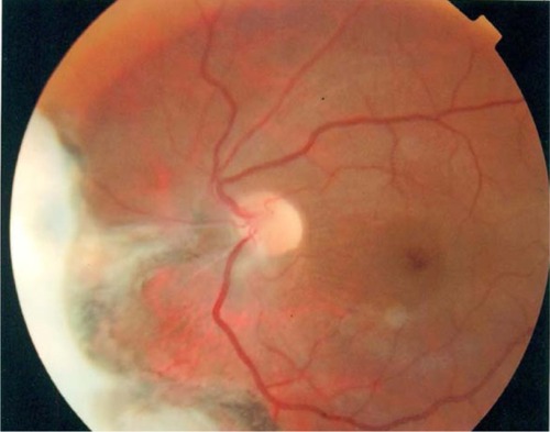 Figure 2 Kaplan–Meier survival distribution plots are generated to display the time of Nd:YAG capsulotomy events.