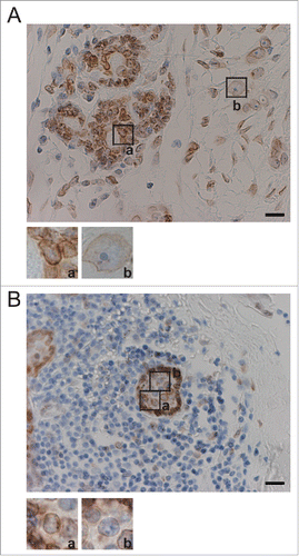 Figure 5. Nucleolar size correlates negatively with SUN1 expression levels in human breast cancer tissues. (A) Breast tumor specimens from patients were stained using anti-SUN1 pAbs (brown), and cells were counterstained with hematoxylin (blue). A representative example both noncancerous and cancerous regions is shown. The left part of this panel shows the cancer-associated noncancerous region maintaining persistent ducts, and the majority of the cells were SUN1 positive. The right part of the panel shows cancerous regions with reduced SUN1 staining. Scale bar = 50 µm. Representative images of SUN1-positive cells with small nucleoli (a) and SUN1-negative cells with enlarged nucleoli (b) are enlarged at the bottom. The areas of the nucleoli in SUN1-positive or in SUN1-negative cells were 118 ± 39 and 37 ± 19, respectively (n >10 cells). (B) Cancer-associated non-cancerous mammary ducts composed of heterogenous population of cells are shown. Small inflammatory cells surround the SUN1-positive mammary duct. Scale bar = 50 µm. A cell with strong SUN1-staining (a) localized to the periphery of the duct and has small nucleolus, while one with faint SUN1-staining (b) is inside of the duct and harbors a large nucleolus.
