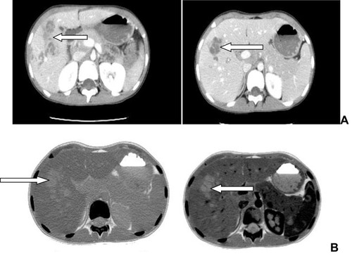 Figure 1 Abdominal CT scans. Plain (A) and contrast-enhanced (B) images. Shows hepatic nodules with no calcification with multiple cysts and small daughter cysts communicating hypoechoic mass-like lesion (arrows).