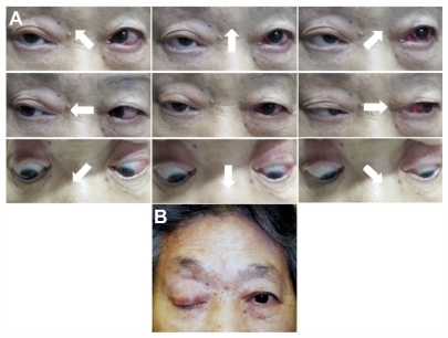 Figure 4 Photographs of eye positions in all directions five months after initiation of therapy. (A) Most ocular movements are markedly improved, except for abduction. Subconjunctival hemorrhage is present in the left eye. (B) Photograph of face one month after initiation of therapy. The skin lesions are almost resolved but ptosis remains.