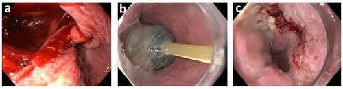 Figure 1. (a–c) Endoscopic view of the esophageal defect in case II. Immediately after pneumatic dilatation, a laceration 3 cm above the Z-line was observed (a). The patient was treated with Eso-SPONGE® vacuum therapy (b). After 5 days, endoscopic inspection showed healing of the esophageal wall defect with granulation tissue (c).