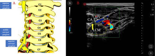 Figure 1 Anatomical structure of the stellate ganglion and the picture of ultrasound-guided stellate ganglion block. (A) Virtual anatomical structure of stellate ganglion. (B) Coronal view of the stellate ganglion with ultrasound scanning.