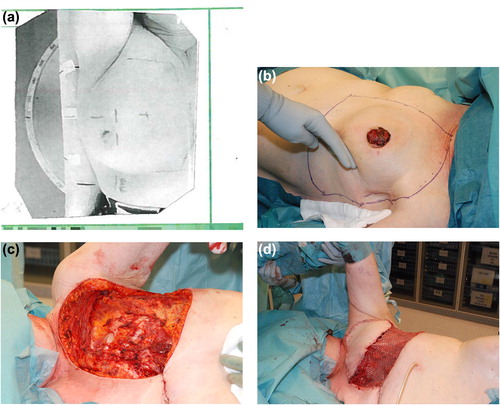 Figure 1a–d. Using the radiotherapy dose planning charts the resection area is planned, patient 3 (a). The irradiated area is marked to define the extent of the resection (b). The skin and extra thoracic soft tissue is resected (c) and a pedicled flap of the latissimus dorsi and a split-thickness skin graft is used for reconstruction (d), patient 6 (b–d).