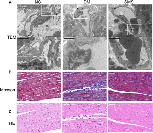 Figure 1 SMS protects ultrastructure integrity and attenuates cardiac fibrosis in diabetic rats. (A) Representative transmission electron micrographs of cardiac tissues (magnification = 15,000×). Scale bar (white) 50 μm; scale bar (black) 20 μm. (B) Representative images of myocardial tissue sections stained with Masson’s trichrome solution (magnification = 400×). Scale bar 50 μm. (C) Standard pictures of myocardial tissue sections stained with hematoxylin and eosin (magnification = 400×). Scale bar 50 μm.