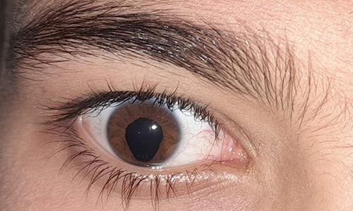 Figure 1 Shows inferonasal iris coloboma in the right eye of the patient.