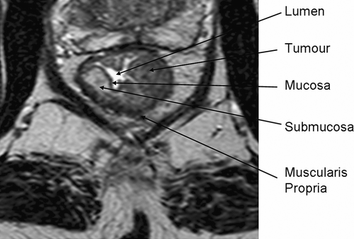 Figure 2.  Detailed anatomy of bowel wall and tumour seen on high-resolution MRI.