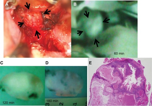 Figure 4 Examination with ICG fluorescence image for recurrent retropharyngeal node from hypopharyngeal carcinoma between 60 minutes and 180 minutes in excised specimens. (A) Intraoperative findings after 60 minutes. The tumor is observed clearly on the white LED light. (B) ICG image 60 minutes after ICG injection. ICG image visualized the tumor clearly under HEMS (Mizuho Medical Co, Ltd, Tokyo, Japan) imaging. (C) 120 minutes after ICG injection. Under HEMS imaging, the excised tumor is moderately fluorescent. (D) 180 minutes after ICG injection. Under HEMS imaging, the excised tumor is slightly fluorescent. (E) Pathological findings.