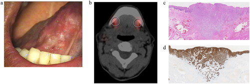 Figure 1. Case 1: imaging and microscopy.a: Pre-operative picture of the painful lesion on the right lateral border of the tongue.b: Axial fused SPET-CT scan after peritumoral injections with a technetium-99m labeled radiotracer followed by lymphoscintigraphy. Circles indicate the sentinel node located in cervical lymph node level Ib.c: Slide of the surgical specimen by light microscopy with histology on 5 µm tissue section with haematoxylin and eosin (H&E) staining, representing the spiky growth pattern of the squamous cell carcinoma (magnification 45x).d: Slide of the surgical specimen by light microscopy with histology on 5 μm tissue section with cytokeratin AE1/3 staining highlighting the infiltrative growth of the neoplastic cells (magnification 45x).