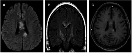 Figure 1 Bran magnetic resonance imaging (MRI) showed some abnormal T2 hyperintense signals involving in the splenium and the body of corpus callosum, midbrain and bilateral internal capsule, with slight contrast enhancement (C).