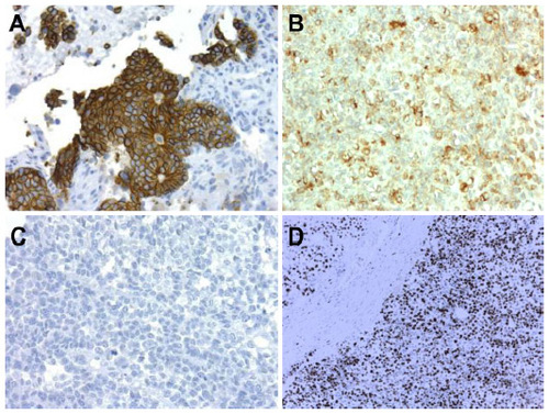 Figure 3 (A) Strong cytokeratin (AE1/AE3) immunoexpression in primitive neuroectodermal tumors, 20×. (B) Moderate epithelial membrane antigen immunoexpression in Ewing sarcoma, 20×. (C) Desmin negativity in Ewing sarcoma, 20×. (D) Strong nuclear Ki-67 expression in Ewing sarcoma, 10×.