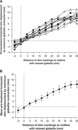 Figure 2 A) Pre-treatment horizontal skin displacement by maximum glabellar contraction in 13 individual patients. Analyzed grid points of interest ran laterally from the midline, immediately above the eyebrow. B) Mean values ± standard deviation of the 13 patients in Figure 2A.