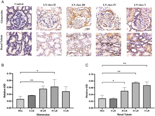 Figure 6. Renal TNF-RI expression in LN patients and controls. (A) Images show TNF-RI immunostaining in the glomeruli and tubulointerstitium. A representative image was shown (scale bar 50 µm); The positive area was quantified with different types and healthy control in glomerulus (B) and renal tubule (C).*p < .05、**p < .01.