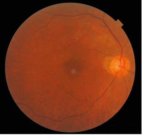 Figure 5 Right eye fundus photograph 4 weeks after initial presentation shows normal retinal characteristics.