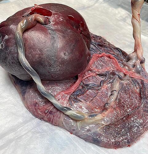 Figure 5 Post delivery image of the placenta and respective umbilical cords of a monochorionic diamniotic twin gestation with reverse twin arterial perfusion (TRAP) sequence delivered spontaneously at 38 weeks’ gestation. Note marginal furcate insertion of the umbilical cord (Figure 4A) of the pump (normal twin) on the right. The umbilical cord of the pump twin feeds directly to the umbilical cord of the acardiac twin’s placenta. The umbilical cord of the acardiac twin contains two vessels and does not communicate with the placenta (Figure 4B).