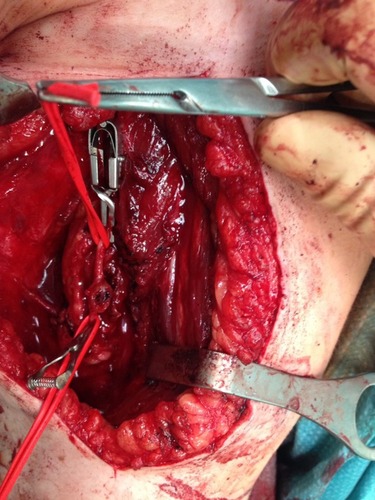 Figure 8 Intraoperative photograph showing the brachial artery pseudoaneurysm (Case #2).