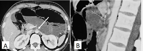 Figure 2 Thrombosis of the superior mesenteric artery (arrows): (A): Axial CT- scan; (B): Sagittal reconstruction.