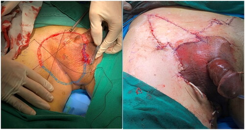 Figure 2. Intraoperative analysis of the margins and flap closure.