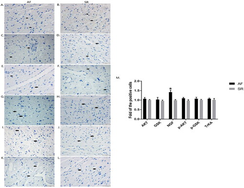 Figure 2. Localizations of AKT, GSK3β, NGF, p-AKT, p-GSK3β and TrKA were detected in right atrial tissues by immunohistochemical assay. Expressions of AKT(A, B)、GSK3β (C, D), NGF(E, F), p-AKT (G, H), p-GSK3β (I, J) and TrKA (K, L) were demonstrated in right atrial tissues of AF patients and SR patients. The scale bar represents 50 μm. The arrows indicate the positive cells with brown granules. The graphs show the density of the target proteins in positive cells. Data were expressed as mean ± SD. *p<.05 vs. SR patients. AF: atrial fibrillation; SR: sinus rhythm; Akt: protein kinase B; GSK3β: glycogen synthase kinase 3β; NGF: nerve growth factor.