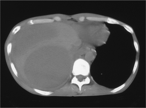 Figure 2 Computed tomography (CT) of the abdomen showing a large liver abscess.