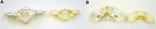 Figure 2 Photographs of the misshapen atlas (left side) and of a control atlas (right side), caudal aspect. The cranial surface (A) shows bilaterally misshapen cranial articular foveae with symmetric transverse folds within the articular surface (*). An approximately 4 mm long fissure (†) of the caudal vertebral arch is present (B) within a bone callus.