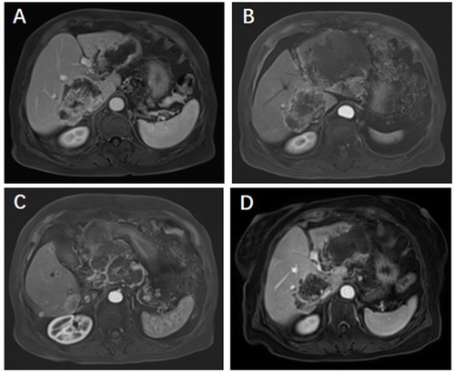 Figure 1 Magnetic resonance imaging for tumors. Magnetic resonance imaging (MRI) scans were performed at initial diagnosed (A), and before (B and C) and after (D) sorafenib therapy.