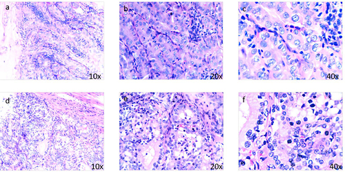 Figure 2 (a–c) Papillary structures are visible, with ground-glass nuclei, nuclear groove, and overlapping nuclei, including pseudo-inclusion bodies; (d-f) Malignant area of struma ovarii. Cellular nuclei show atypia and the tumor has infiltrated into ovarian tissues, which form hyperplastic follicles similar to follicular thyroid cancer, without nuclear grooves, nuclear pseudo-inclusion bodies or nuclear overlap and ground glass nuclei.