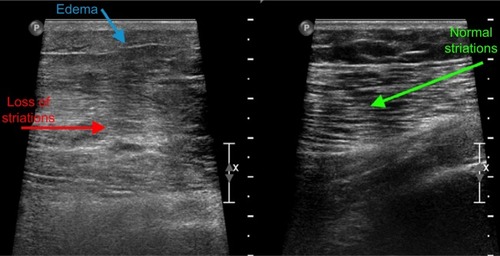 Figure 1 Ultrasound scan targeted on the thigh demonstrates some loss of definition of the normal muscular striations on the right side (red arrow), with an increase in generalized edema, particularly subcutaneous edema (blue arrow).