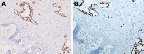 Figure 3 (A) On immunohistochemical analysis, tumor cells were positive for cytokeratin 7. (B) TTF-1 immunohistochemistry shows strong nucleus staining in the tumor cells, original magnification ×100. Scale bar 400 μm.