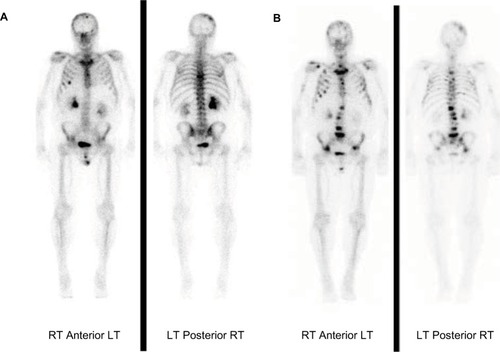 Figure 4 Baseline (A) and post-therapy bone scan (B) showing increasing number of bone metastases in a patient with no pain at baseline and at the end of therapy and maintained normal active functional status.Abbreviations: LT, left; RT, right.