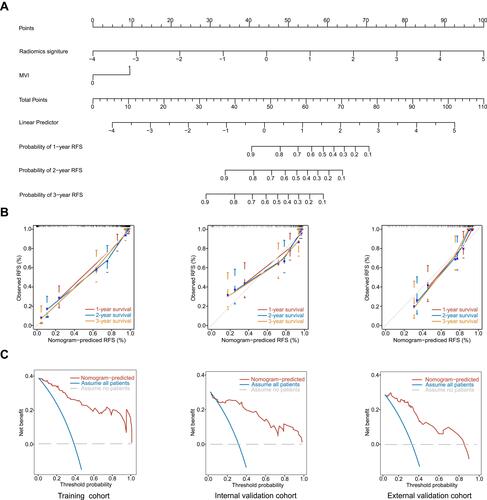 Figure 2 Combined nomogram used to estimate RFS for HCC, along with the calibration curves and decision curves for the Combined nomogram. (A) The Combined nomogram for RFS. (B) The calibration curves for the Combined nomogram in the training, the internal and external validation cohorts. (C) The decision curves for the Combined nomogram in the training, the internal and external validation cohorts.