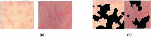 Figure 3. Segmentation of maculopapular rash: (a) Original image, (b) Segmented maculopapular rash using the segmentation tool.