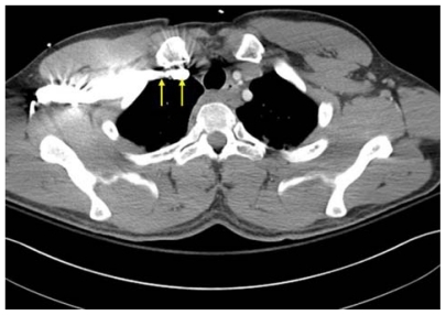 Figure 10 Computed tomography scan demonstrating apposition of right subclavian vein to pleura (arrows).