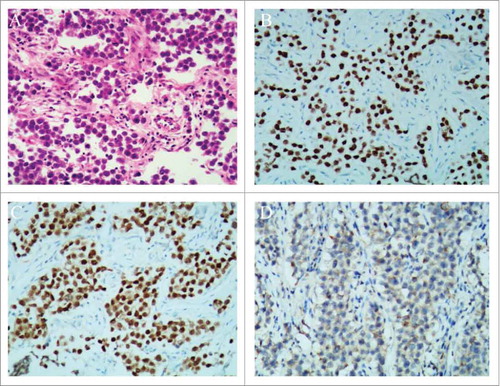 Figure 2. Histopathological results of the ovarian dysgerminoma and immunohistochemical staining. (A) Histopathology showing sheets of tumor cells, separated by fibrous septa (H & E stain, × 100). (B) SALL-4 staining was positive (SALL-4, × 100). (C) Oct-4 staining was positive (Oct-4, × 100). (D) CK staining was weekly positive (CK, × 100).