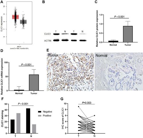 Figure 1 Expression of CLIC1 in breast cancer.