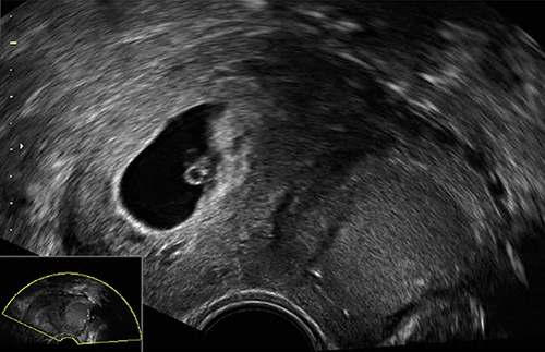 Figure 2 Transvaginal ultrasound in October 2022 shows the normally sited pregnancy within the uterine cavity to the patient’s right and, clearly separated from it, the cystic adenomyoma to the patient’s left. Its sonographic appearance is unchanged compared to the previous scans.