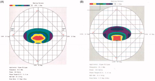 Figure 2. (A) Initial hyperthermia plan with phase target at (0, −2 cm) and power density distribution of 50–75%. (B) Hyperthermia plan with phase target at (0, −6 cm) and power density distribution around the bladder was reduced to below 50% after sparing the bladder.