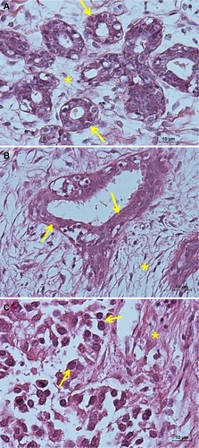 Figure 3 Hematoxylin and eosin images. (A) Normal mammary tissue, (B) fibroadenoma tissue, and (C) invasive ductal carcinoma tissue. Yellow arrows indicate ductal cells while the stroma is indicated by asterisks. Scale bar 10 μm.