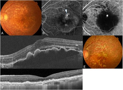 Figure 3 A 78-year-old woman presented with decreased visual acuity in her left eye. (A) A color fundus photograph of the left eye showing multiple soft drusen and reticular pseudodrusen. (B) Late-phase fluorescein angiographic image of the fundus showing leakage from a retinal–retinal anastomosis (white arrowhead). (C) A hot spot consistent with neovascularization is clearly identified by indocyanine green angiography. (D) SD-OCT at baseline revealing elevated PED with subretinal fluid. The visual acuity was 20/40 in the left eye, and the patient was diagnosed as having RAP stage 2 with PED. (E) In total, 6 ranibizumab injections were administered. Finally, at the 67-month follow-up examination, the patient’s visual acuity had stabilized at 20/40. (F) SD-OCT showing the remaining RPE and outer retina.