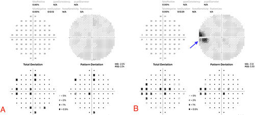 Figure 1 (A) 10–2 Visual field (VF): OD mild scattered VF depression. (B) 10–2 Visual field (VF): OS mild scattered VF depression and scotoma. Arrow pointing to a wedge-shaped scotoma.