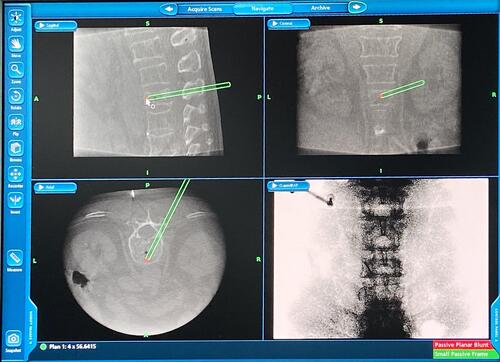 Figure 3 Computer navigation planning route, accurate for identifying the fracture of the vertebral fissure.